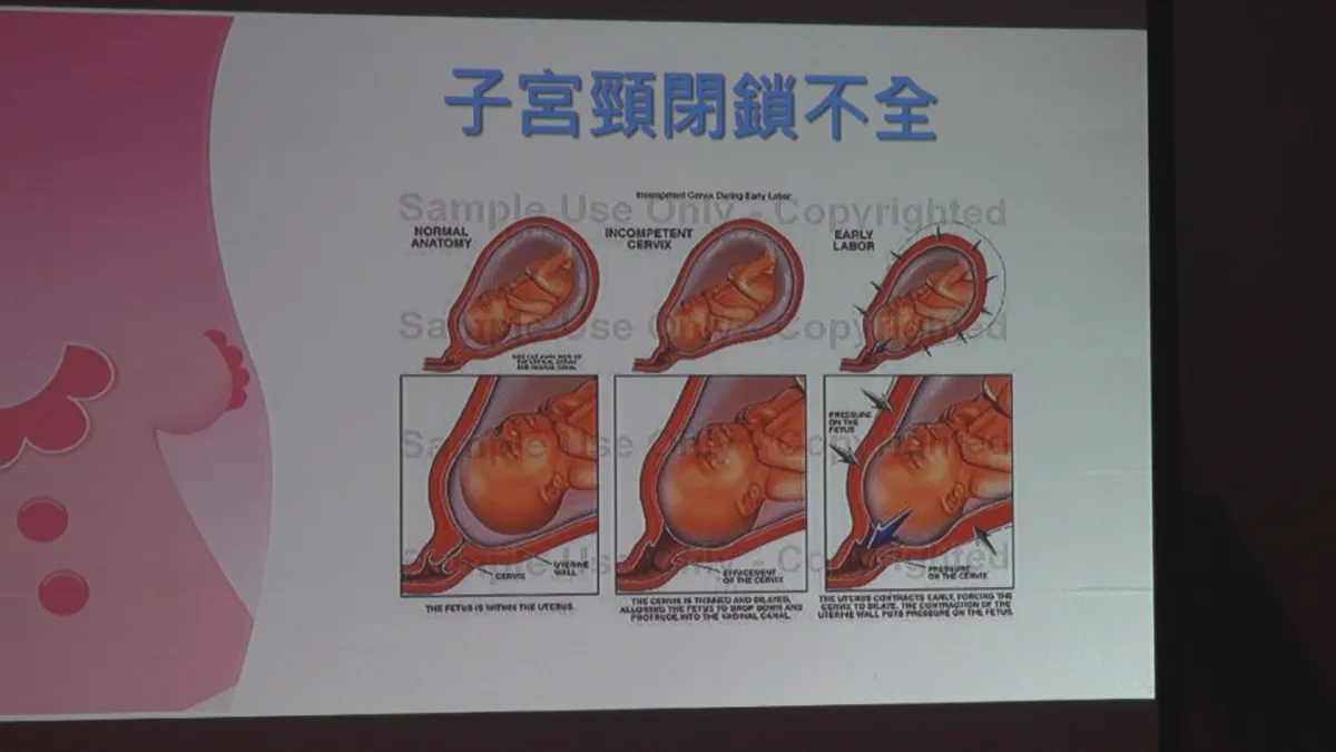 子宮肌腺症難「好孕」 整合治療圓夢當媽
