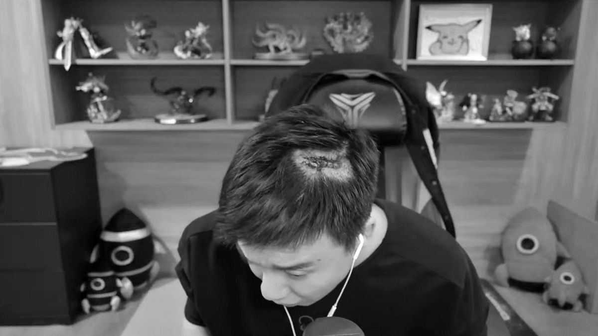 Toyz秀出頭上傷痕。(圖/翻攝自YouTube/Toyz) Toyz秀出頭上傷痕。(圖/翻攝自YouTube/Toyz)