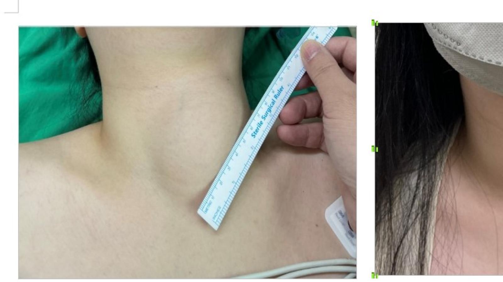 30歲女脖子卡卡、吞嚥不順!竟是8公分大甲狀腺結節作祟 微創手術傷口僅針孔大
