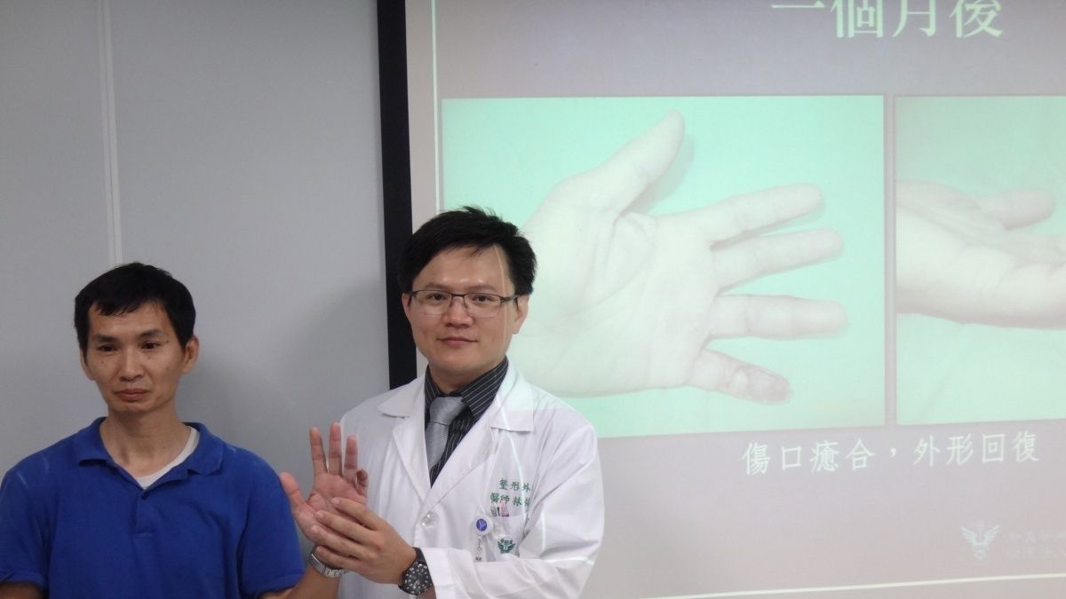 急診創傷手外傷佔兩成 交指皮瓣重建確保功能回復 急診創傷手外傷佔兩成 交指皮瓣重建確保功能回復