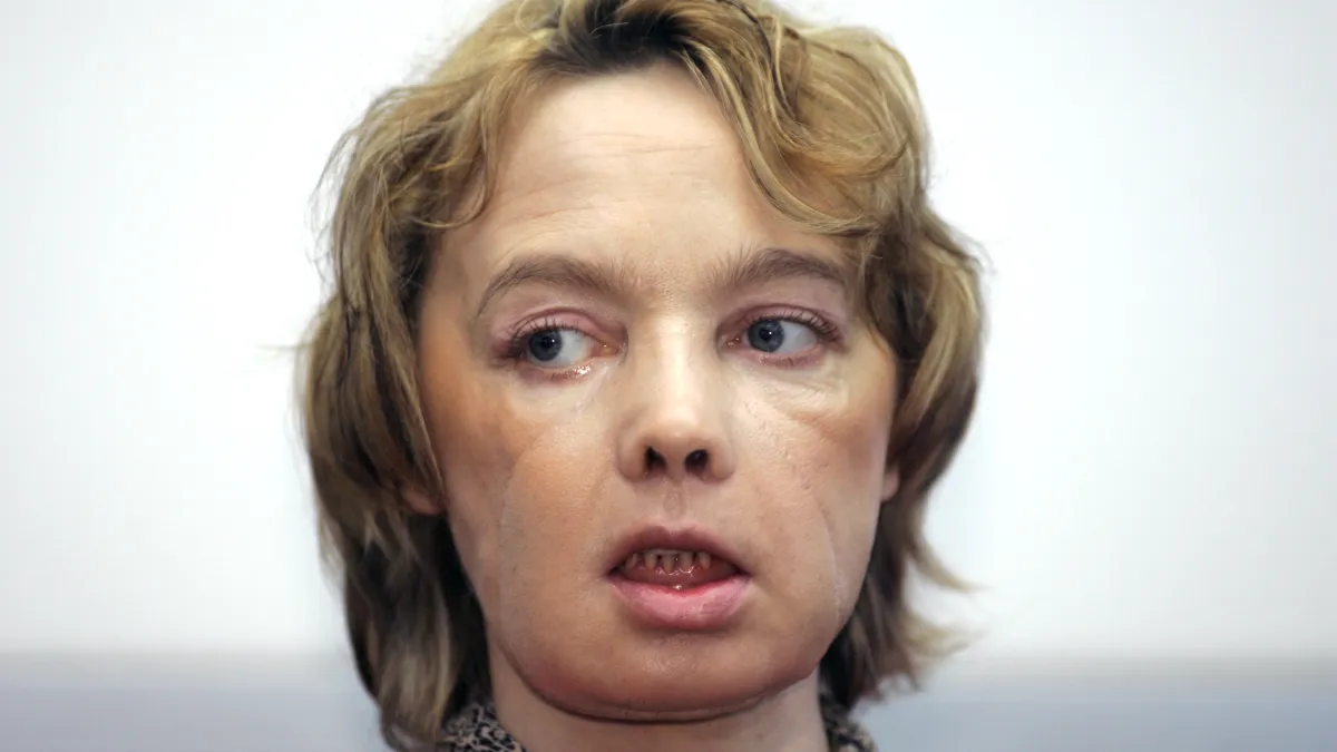 醫療史上第一位成功進行臉部移植的法國女裁縫迪諾亞。(美聯社)