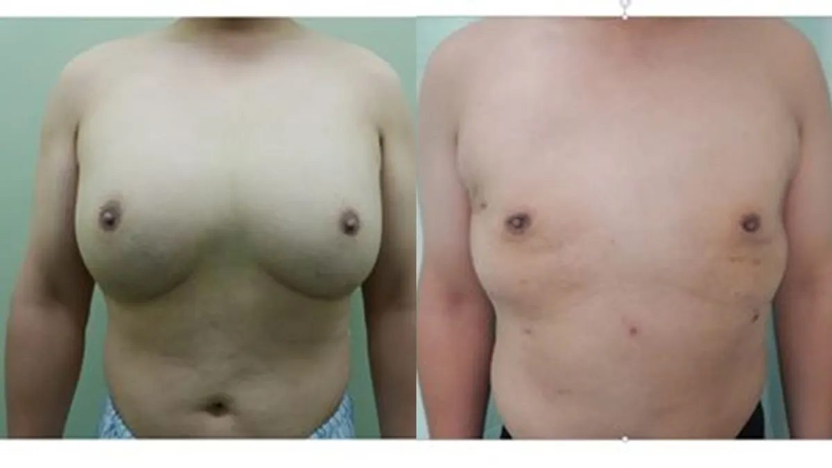 賴鴻文醫師表示,小沈雙側乳房相當於D-E罩杯的身材。(圖片/彰化基督教醫院提供) 賴鴻文醫師表示,小沈雙側乳房相當於D-E罩杯的身材。(圖片/彰化基督教醫院提供)