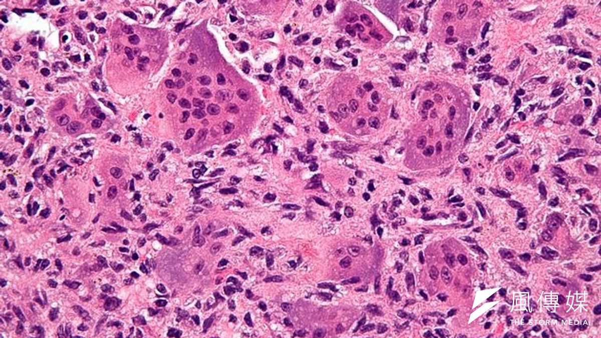 骨癌細胞(維基百科) 骨癌細胞(維基百科)