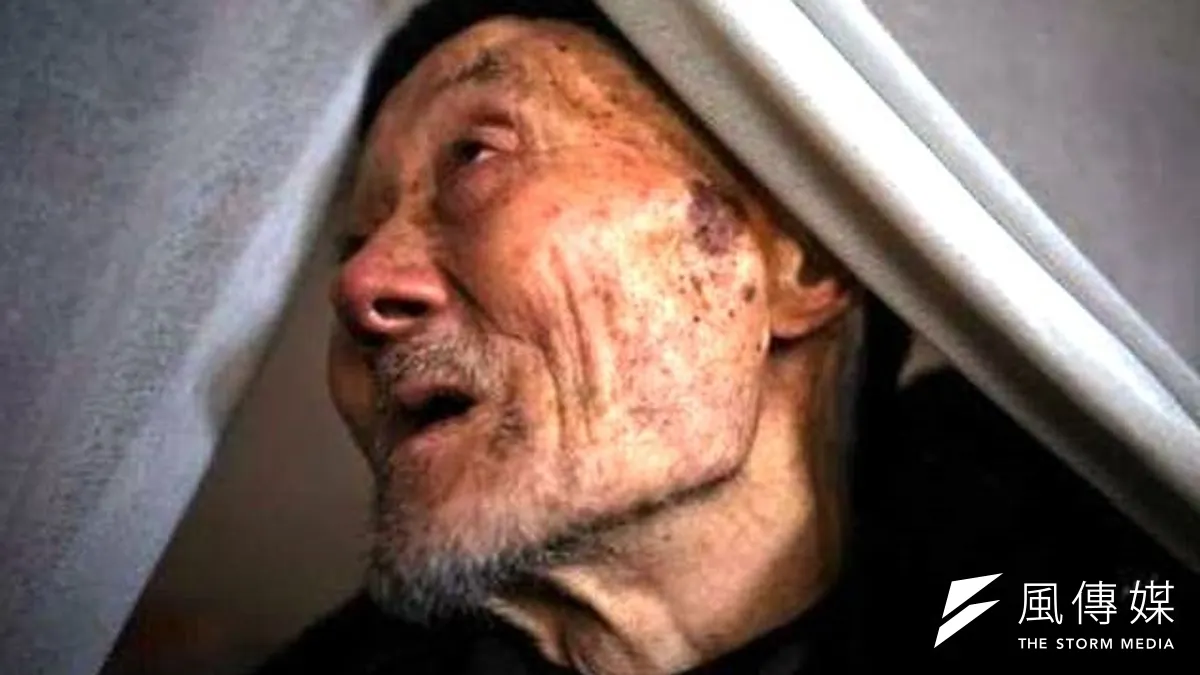 罹患皮膚癌的村民,臉上佈滿砷斑。(取自網路) 罹患皮膚癌的村民,臉上佈滿砷斑。(取自網路)