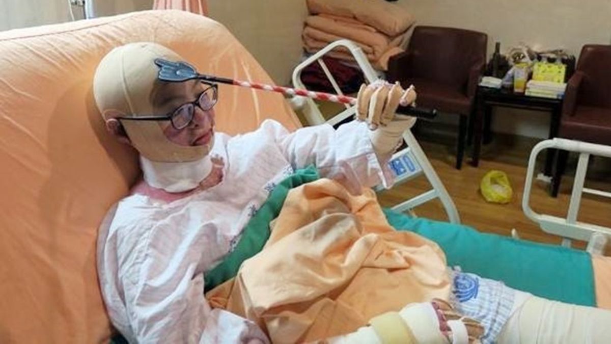 戴著壓力頭套,依欣只能用不求人止癢。(圖/時報出版提供) 戴著壓力頭套,依欣只能用不求人止癢。(圖/時報出版提供)