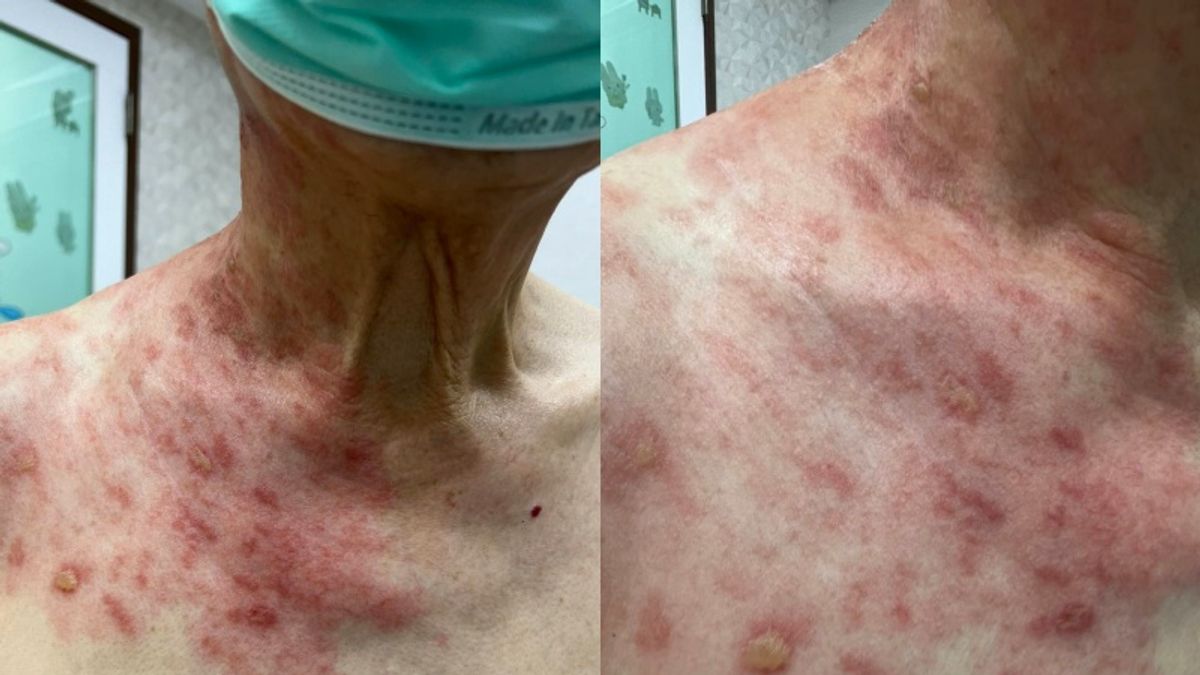 醫師表示,不是每個人確診都這麼幸運,不應該把新冠看作單純感冒而已。(圖/取自黎博彥診所臉書) 醫師表示,不是每個人確診都這麼幸運,不應該把新冠看作單純感冒而已。(圖/取自黎博彥診所臉書)