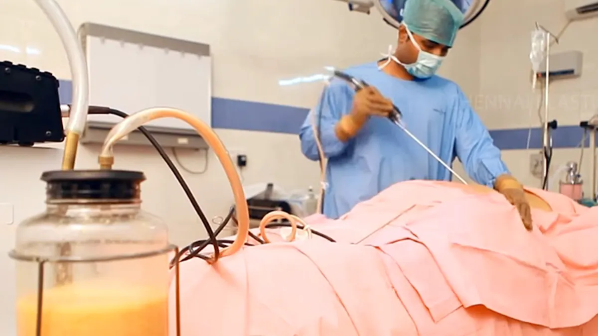 抽脂並非人人皆宜,也不是節食和運動的理想替代方法!(翻攝自YouTube) 抽脂並非人人皆宜,也不是節食和運動的理想替代方法!(翻攝自YouTube)