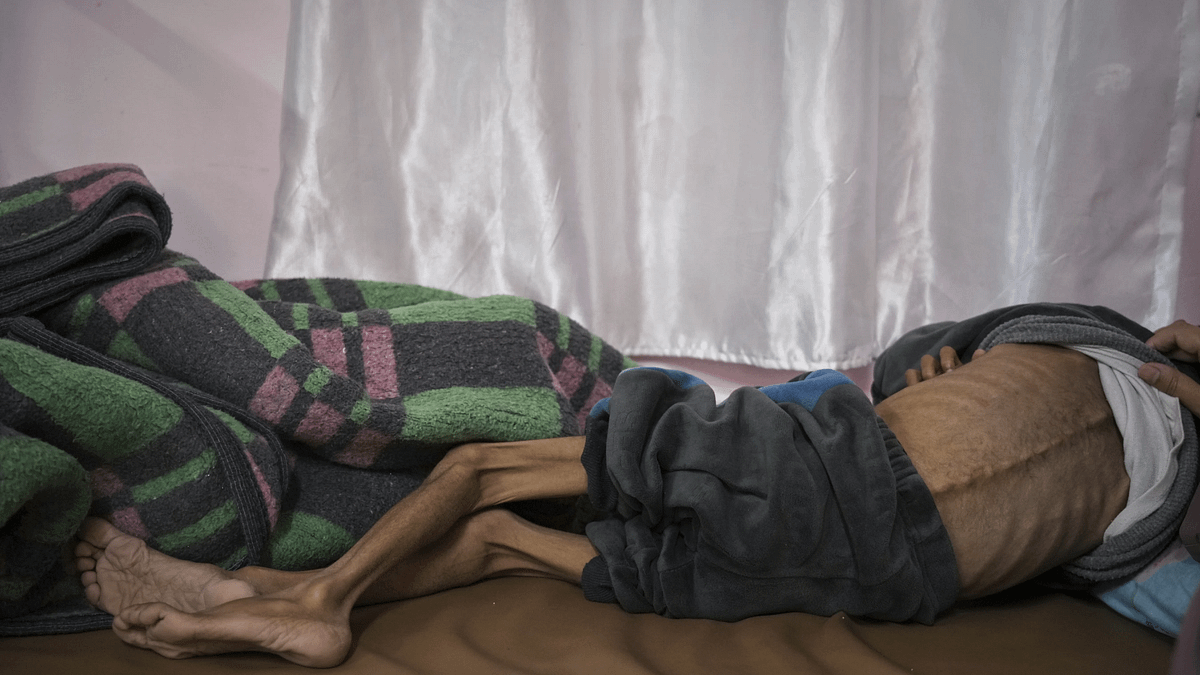 飢荒席捲加薩,圖為一名骨瘦如柴的5歲加薩孩童。聯合國指出,多達90萬名加薩兒童長期挨餓,已有7萬人出現營養不良徵兆。(美聯社) 飢荒席捲加薩,圖為一名骨瘦如柴的5歲加薩孩童。聯合國指出,多達90萬名加薩兒童長期挨餓,已有7萬人出現營養不良徵兆。(美聯社)