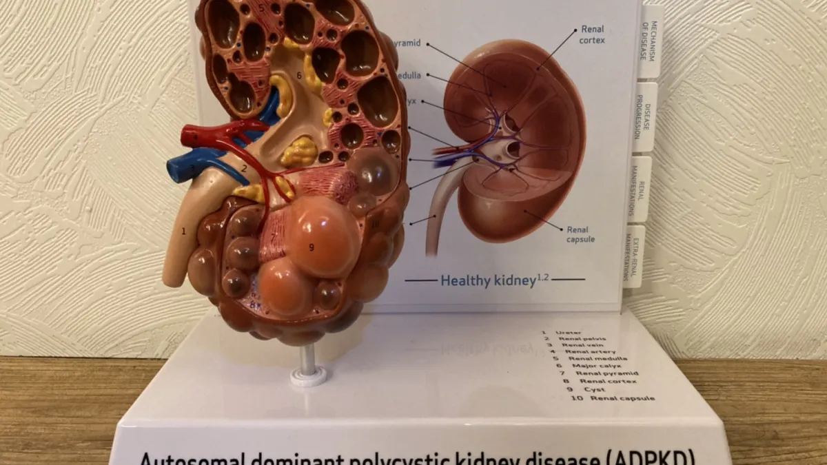 俗稱「泡泡腎」的多囊腎因高疑傳機率讓患者不敢有接婚生子念頭。