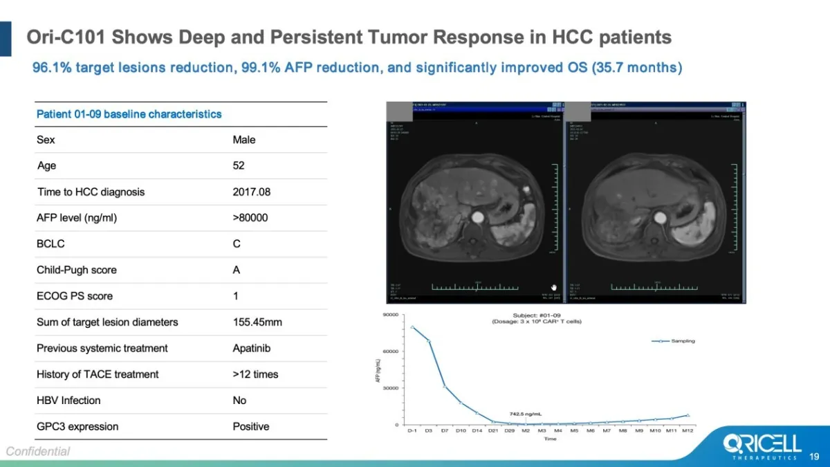 ASCO 2026 | Oricell's GPC3 CAR-T Ori-C101 Hits 66.7% ORR in Late-Line HCC, Signaling Best-in-Class Potential