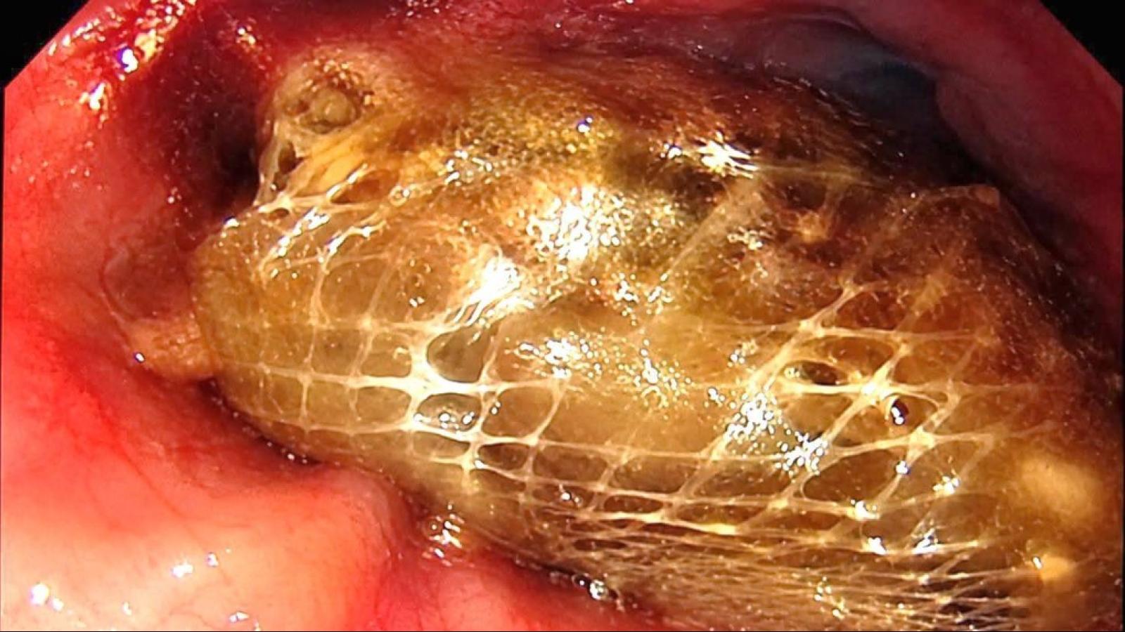 邊吃邊聊要當心!男吞海帶卡食道胃鏡「撈」出異物 醫師:魚刺、肉塊、菇類、麻糬是高風險食物
