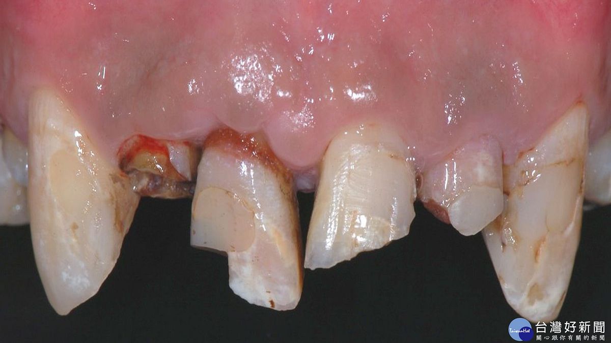 牙齒撞傷需冷靜 找回斷牙保持潮濕盡快就醫 牙齒撞傷需冷靜 找回斷牙保持潮濕盡快就醫