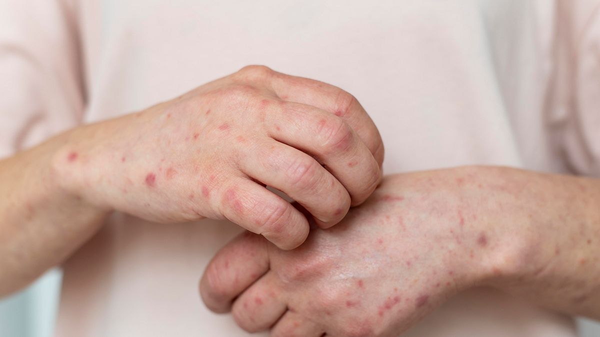 麻疹確診者足跡曝!曾搭「2公車」、板南線坐「3站」到西門,從光華一路逛到西門町