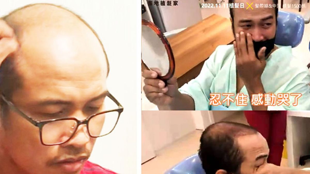 1500根完成髮際線重建及中頂加密!患者術後看到鏡中的自己,超乎預期的滿意效果,忍不住感動落淚。(圖/業者提供) 1500根完成髮際線重建及中頂加密!患者術後看到鏡中的自己,超乎預期的滿意效果,忍不住感動落淚。(圖/業者提供)