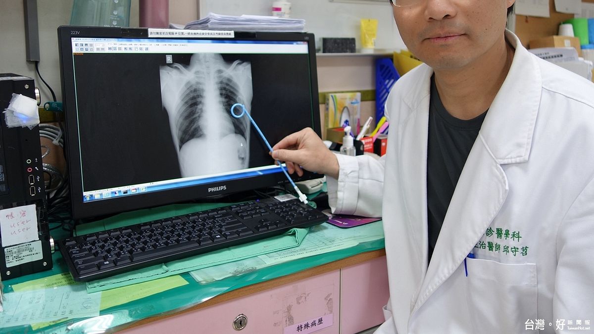 男子針灸後呼吸困難 北醫放置胸管治療後康復出院 男子針灸後呼吸困難 北醫放置胸管治療後康復出院