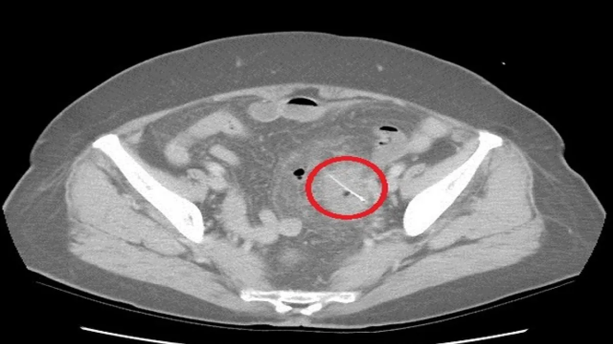 85歲老婦吃火鍋魚刺穿腸 忍了三天才就診