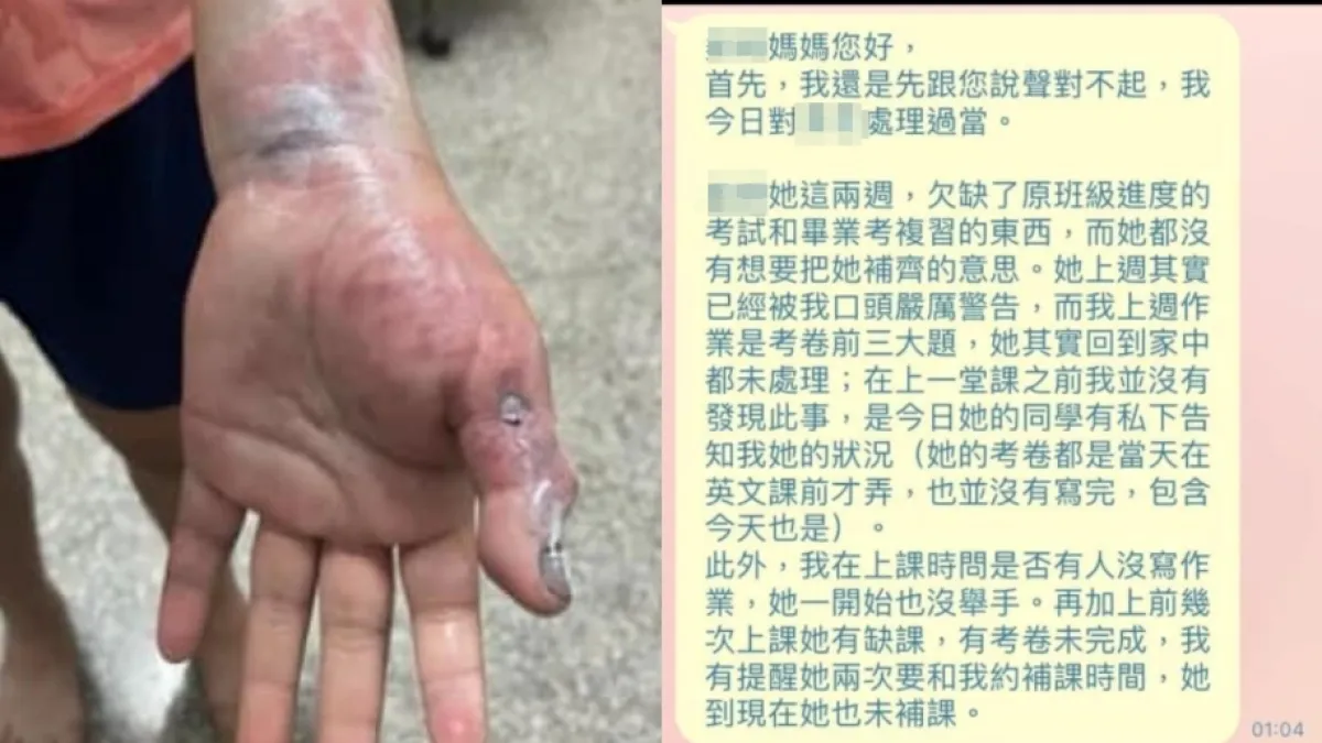 雲林驚傳安親班老師不當體罰,女童手掌被打到傷痕累累,令人怵目驚心。(圖/翻攝自臉書)