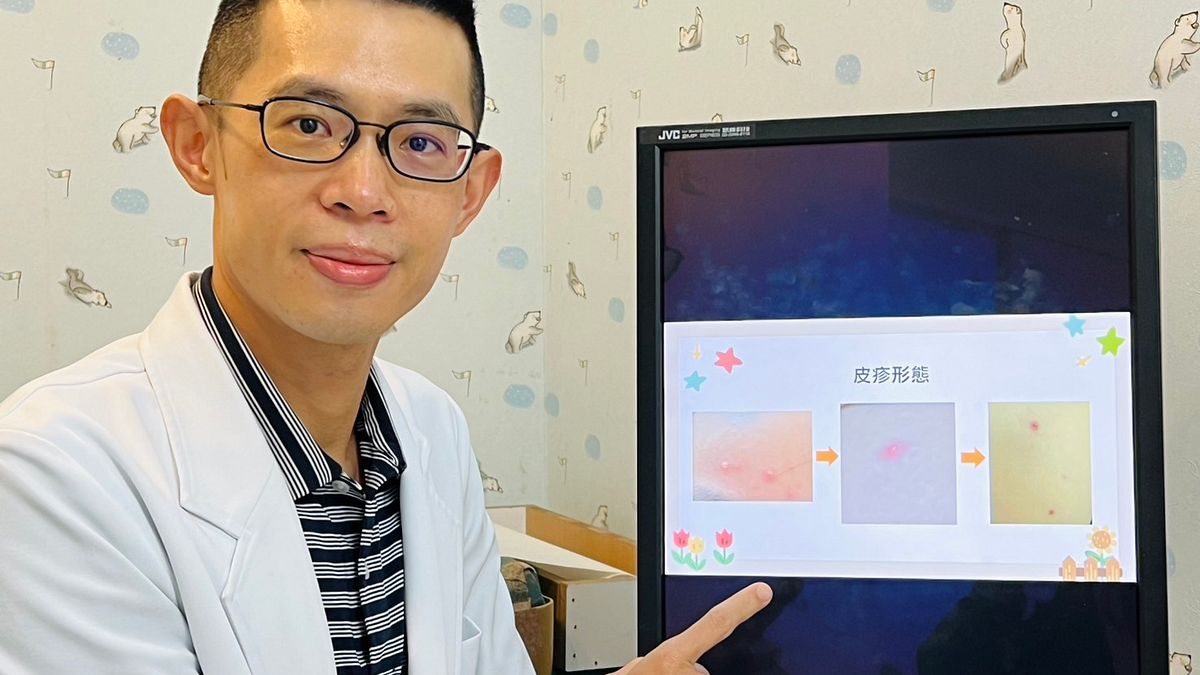 起紅疹以為蟲咬,3天未退確診水痘 醫師提醒:成人症狀常較孩童嚴重
