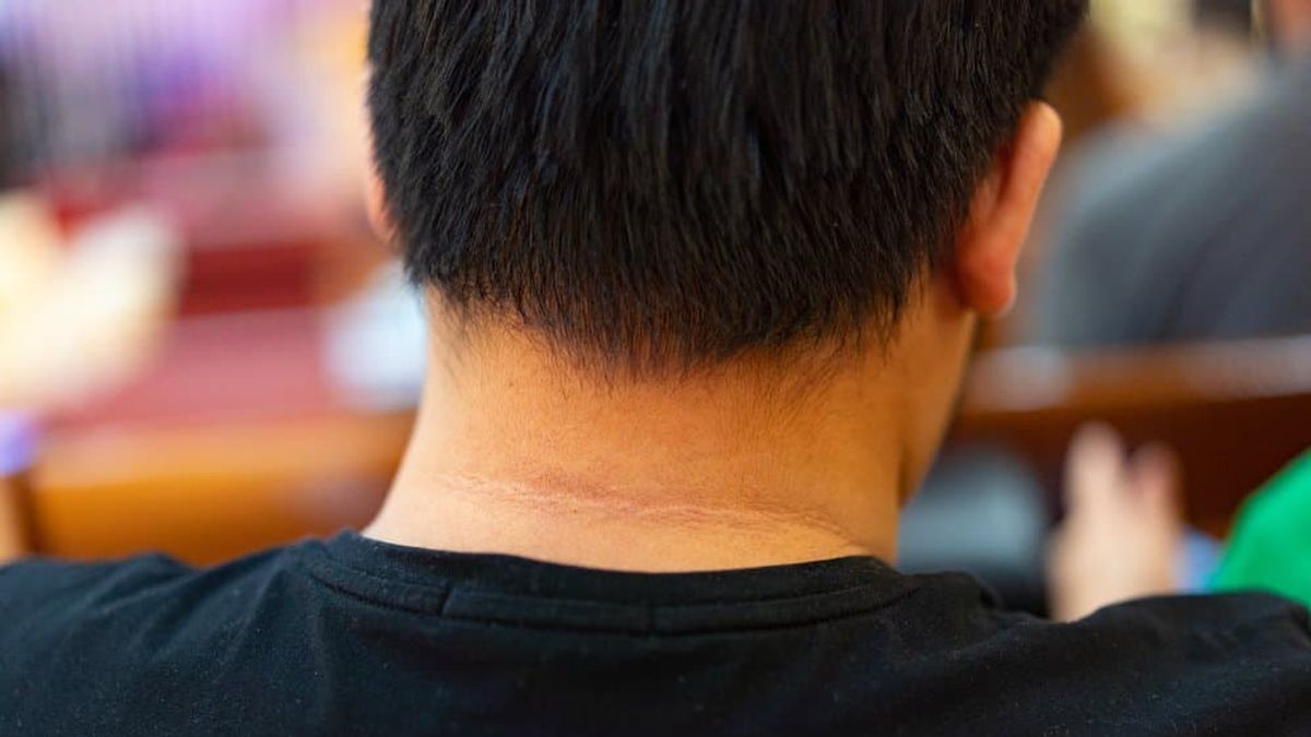 脖子黑黑的洗不掉,可能是黑色棘皮症作祟。(示意圖/Hello醫師提供) 脖子黑黑的洗不掉,可能是黑色棘皮症作祟。(示意圖/Hello醫師提供)