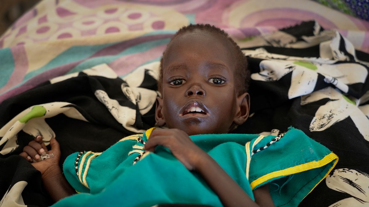 2021年12月28日,南蘇丹瓊萊州方加克縣首府老方加克鎮,1歲女童瓦爾(Chuoder Wal)嚴重營養不良(美聯社) 2021年12月28日,南蘇丹瓊萊州方加克縣首府老方加克鎮,1歲女童瓦爾(Chuoder Wal)嚴重營養不良(美聯社)