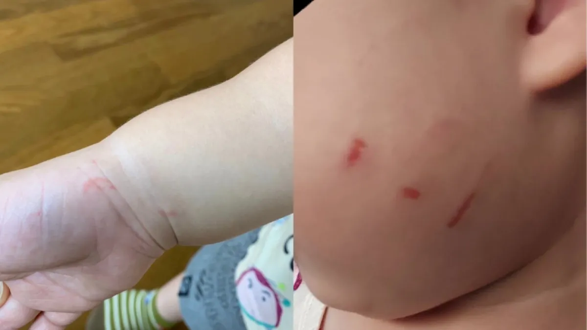 高雄一所幼兒園被爆出有一名男老師對3歲男童施暴,使男童的手臂和臉頰上都出現血痕。(圖/翻攝自臉書)