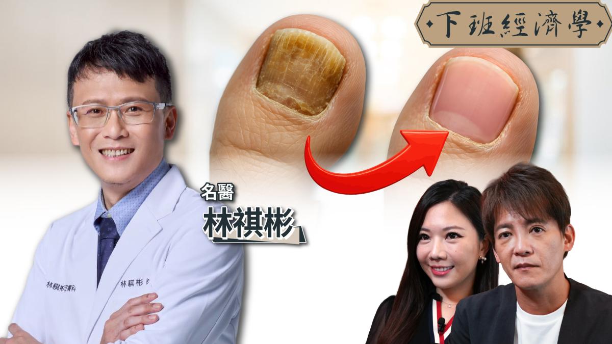 【下班經濟學】注意!別再亂擦藥膏!醫師公開真正根治方法,黴菌一次清乾淨!