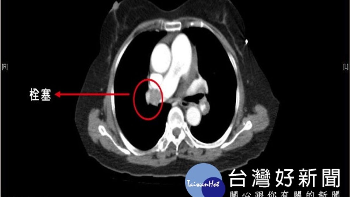 呼吸次數每分28下 7旬老婦肺栓塞挽回一命 呼吸次數每分28下 7旬老婦肺栓塞挽回一命