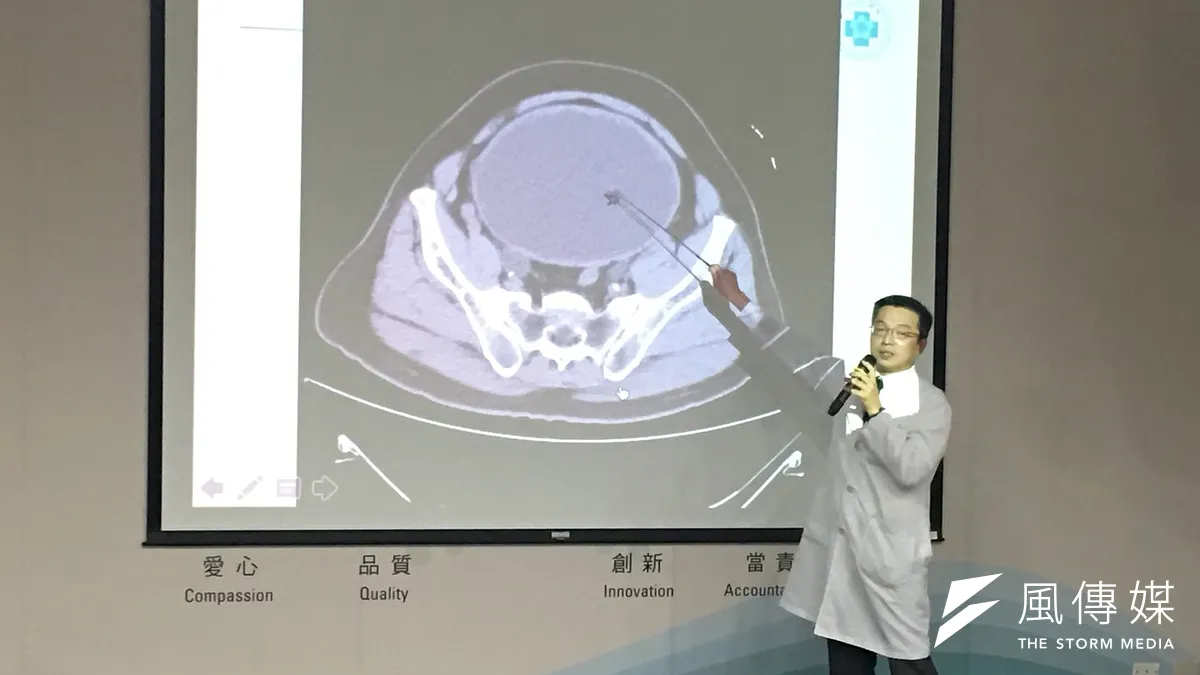 台中榮總醫院泌尿外科醫師陳正哲說明患者病例,因攝護腺肥大導致排尿問題,差一點引發尿毒症。(圖/王秀禾攝)