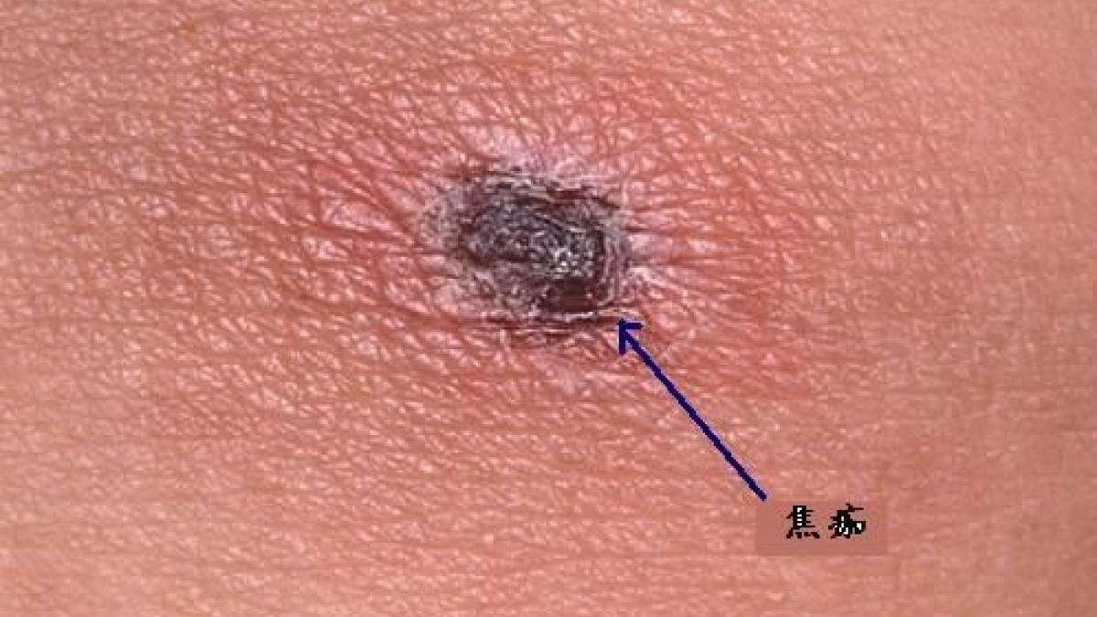 暑假出遊注意!恙蟲病創4年新高 身體出現「這特徵」很可能被叮上了