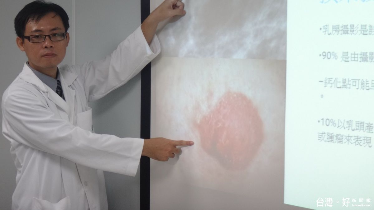 乳房原位癌存活率近百 佳里奇美醫院籲患者早期治療 乳房原位癌存活率近百 佳里奇美醫院籲患者早期治療