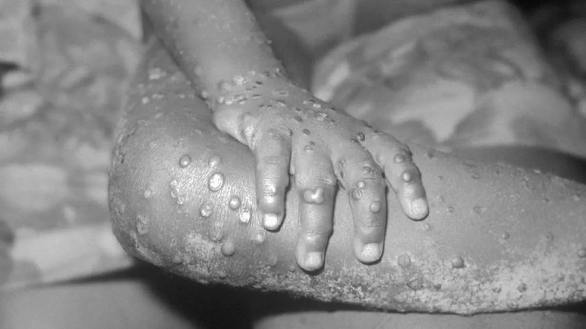猴痘(monkeypox)是一種由猴痘病毒引起的,主要在靈長類、嚙齒類動物中傳播的疾病,1970年於非洲薩伊首次出現人類感染個案,其後於中非及西非等國家熱帶雨林區出現散發性流行。(維基百科)