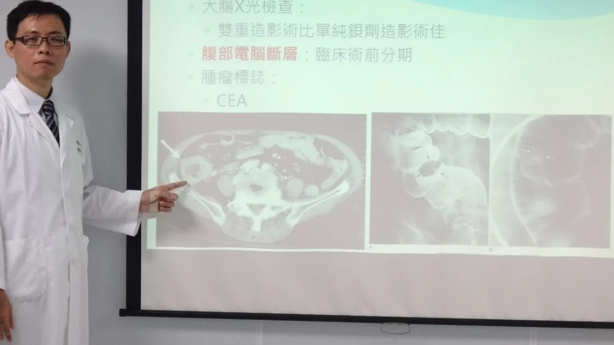 國人大腸癌新增人數最多 醫師呼籲早發現早治療
