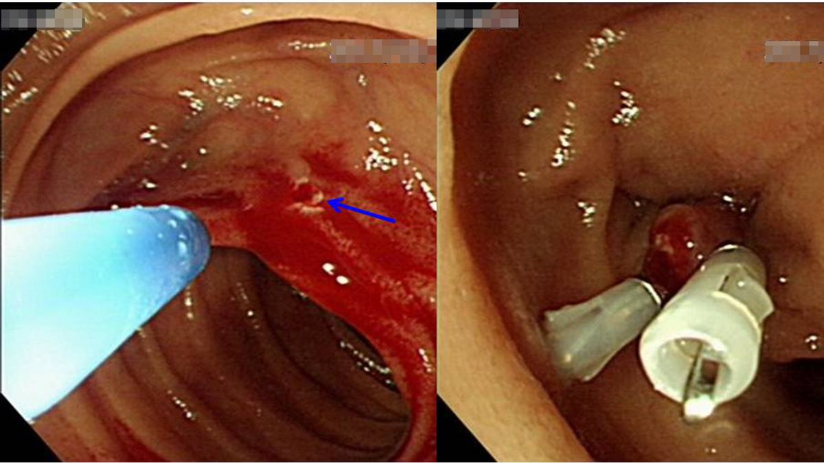 透過小腸內視鏡影像下,肝膽腸胃科醫師發現,患者空腸處血管顯露且出血(左圖箭頭處)。(圖/新竹馬偕醫院提供) 透過小腸內視鏡影像下,肝膽腸胃科醫師發現,患者空腸處血管顯露且出血(左圖箭頭處)。(圖/新竹馬偕醫院提供)
