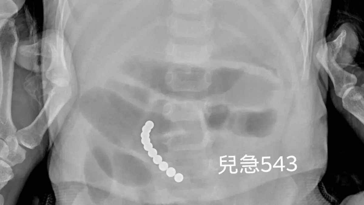 一名2歲男童誤食巴克球,導致連日嘔吐、腸道遭穿破。(圖/擷取自來講兒科急診的543-吳昌騰醫師FB)