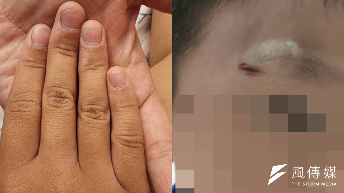 女教師拿書本打孩子眼睛,孩子跌倒撞到桌子導致眼部受傷流血。(圖/家長提供) 女教師拿書本打孩子眼睛,孩子跌倒撞到桌子導致眼部受傷流血。(圖/家長提供)