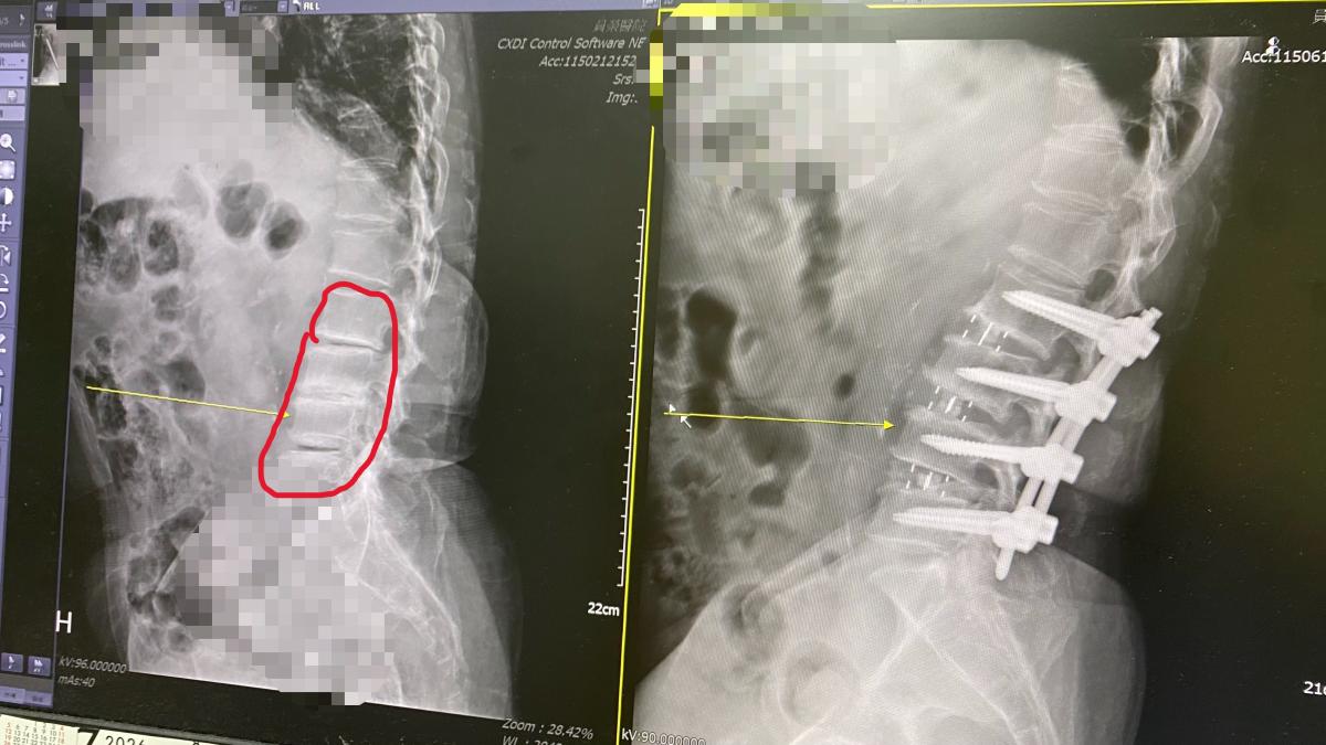 76歲駝背翁找回挺拔人生!醫靠微創手術植入「千斤頂」:腰越來越彎別再忍