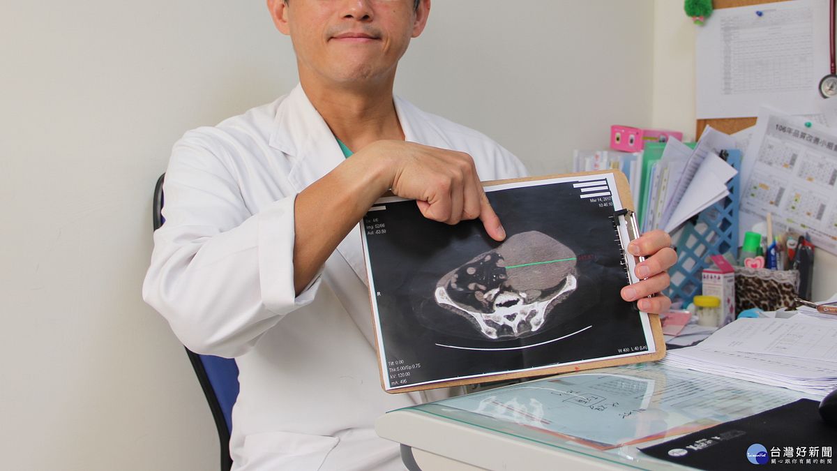 巨大腫瘤藏腹中 竟是罕見腹壁肉癌 巨大腫瘤藏腹中 竟是罕見腹壁肉癌