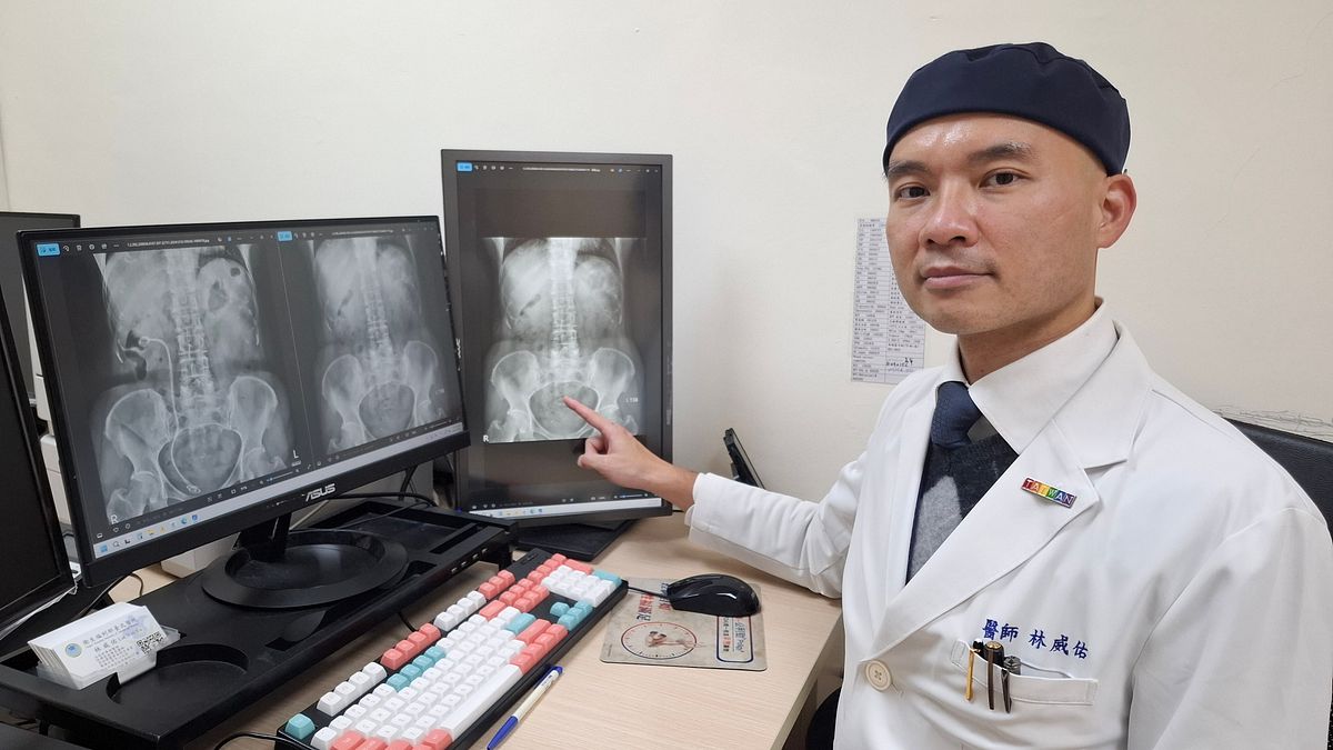 輸尿管狹窄患者新選擇 全覆膜金屬支架助擺脫反覆換管之苦