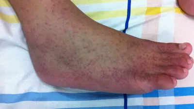 美國疾病管制與預防中心(CDC)注意中國屈公病疫情,已針對廣東發布第二級旅遊警示(圖/維基百科)
