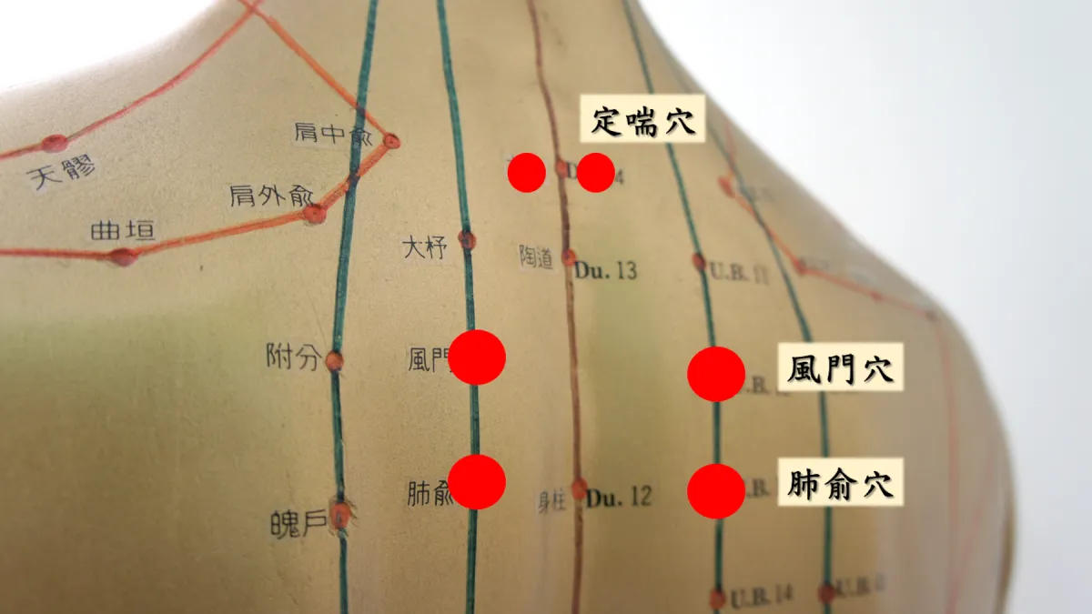 三伏貼治療 中醫師:孕婦和一歲以下小孩不宜