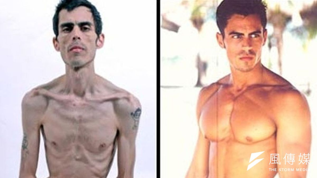 吉里策爾(Jeremy Gillitzer)曾是一名男模,後來染上厭食症,2010年去世時體重僅29公斤(取自網路) 吉里策爾(Jeremy Gillitzer)曾是一名男模,後來染上厭食症,2010年去世時體重僅29公斤(取自網路)