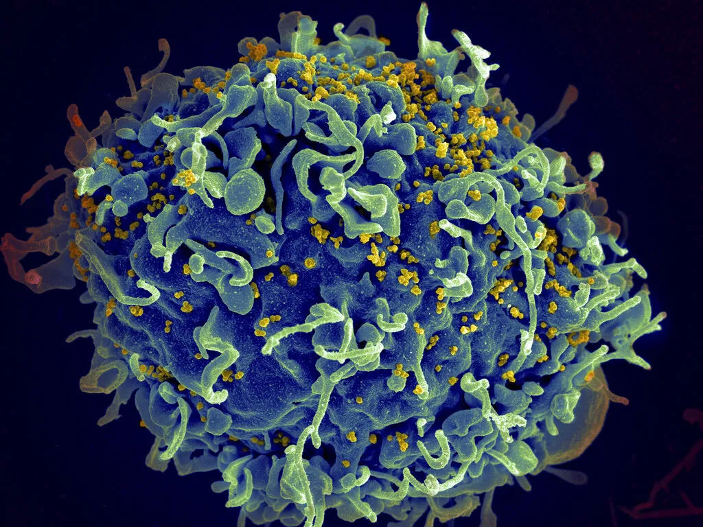 電子顯微鏡底下的人類T細胞（藍色部分）正遭到人類免疫缺乏病毒（HIV，黃色部份）攻擊。（美聯社）