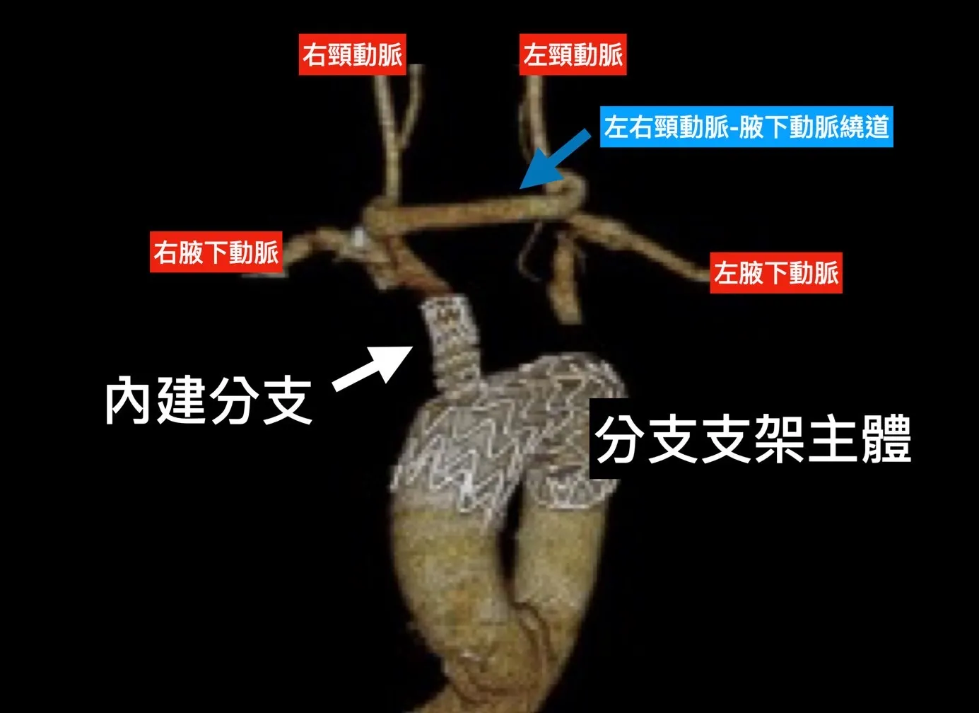 20250619-胸主動脈分支支架圖。（長庚醫院提供）