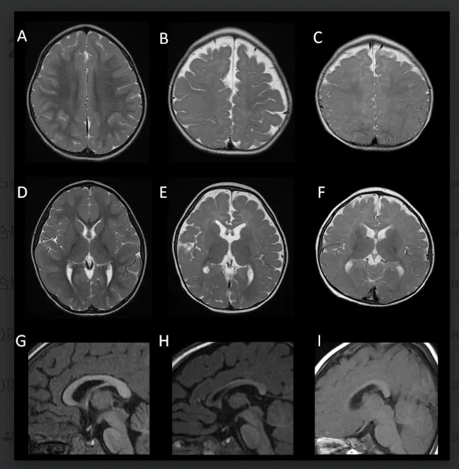 20250630-FOXG1症候群的腦部磁振造影。（陽明交大提供）