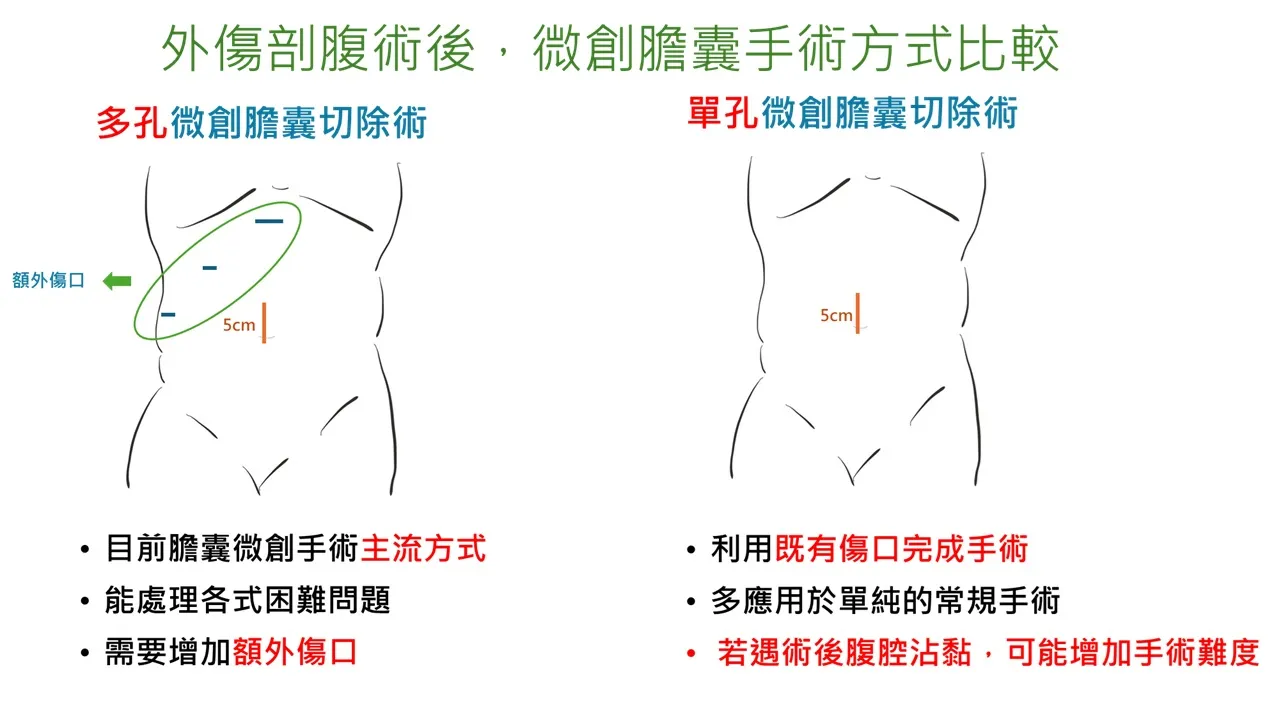 外傷剖腹術後，微創膽囊手術方式比較，右方的單孔微創手術對病人的風險較小。（亞東醫院提供）