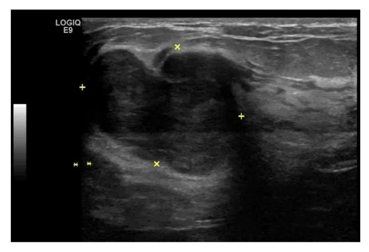 20250722-術前超音波可見有一約3公分大的腫瘤。（4個黃色+字標記處）。（台北慈濟醫院提供）
