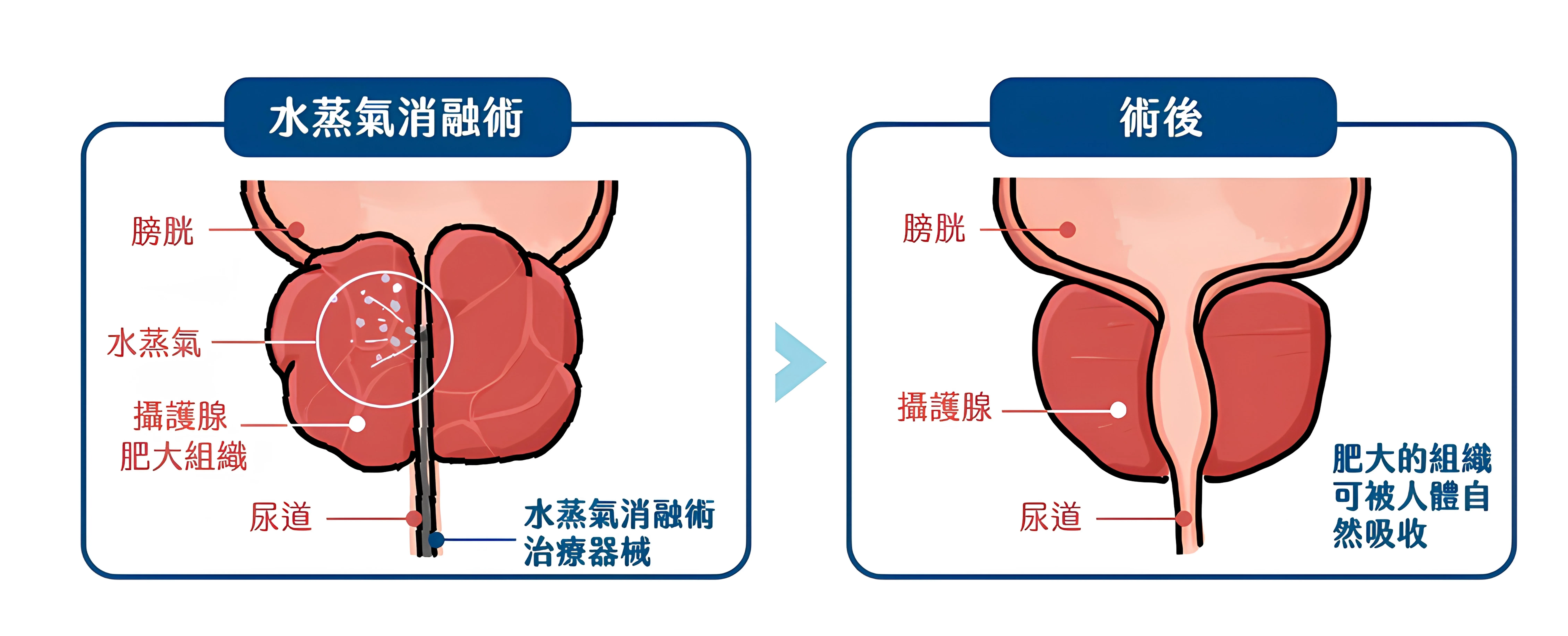 20250806-攝護腺水蒸氣微創消融手術乃以細針將水蒸氣注入攝護腺，使攝護腺萎縮，最終被人體自然吸收。上圖左為治療前，右為治療後。（林口長庚醫院提供）