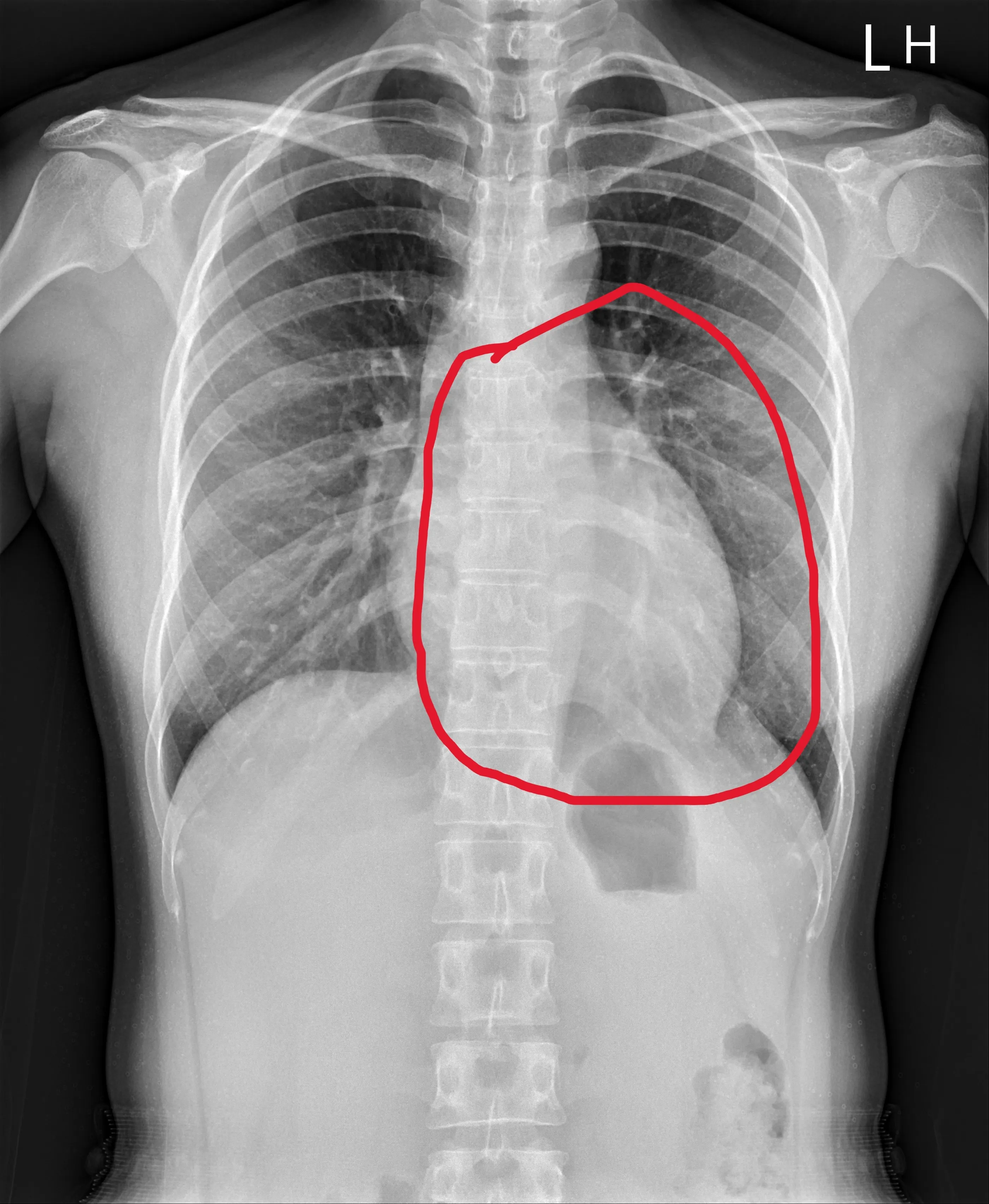 20250815-26歲患者去年7月就醫時，心臟（ 紅線圈內）顯得較肥大。（員榮醫院提供）