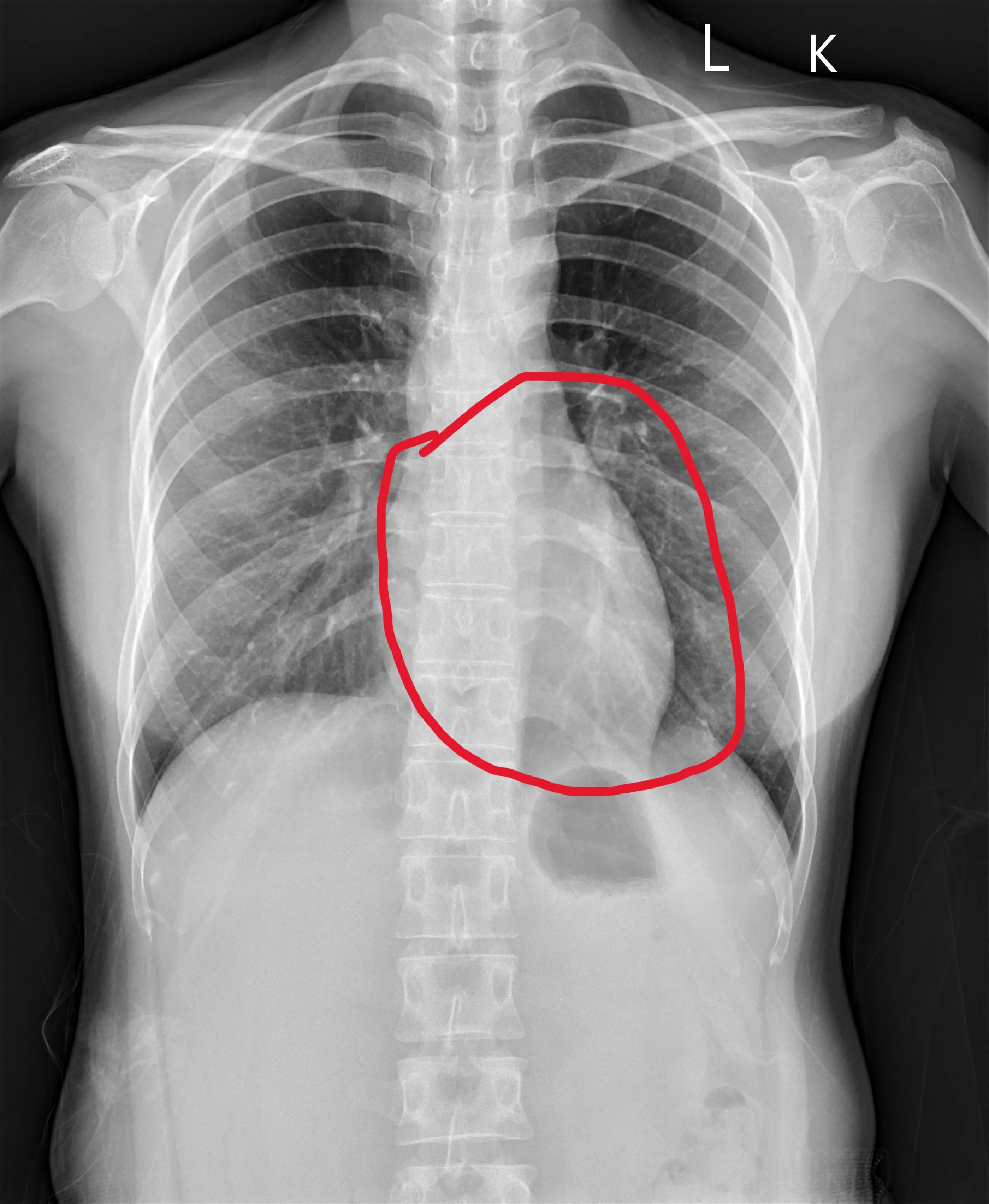 26歲患者今年6月的X光，顯示經過10個月的治療，其心臟（紅圈內）已明顯縮小。（員榮醫院提供）