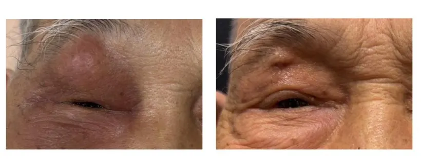 20250820-李爺爺因急性鼻竇炎眼周腫痛（左），經鼻竇內視鏡及上眼皮引流手術後，順利恢復原貌。（台北慈濟醫院提供）